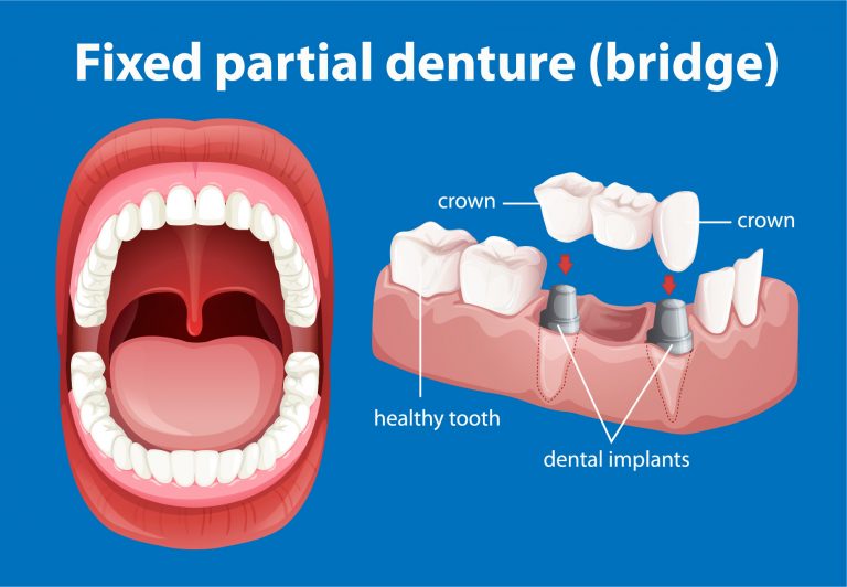 dental-implants-bridge.jpg