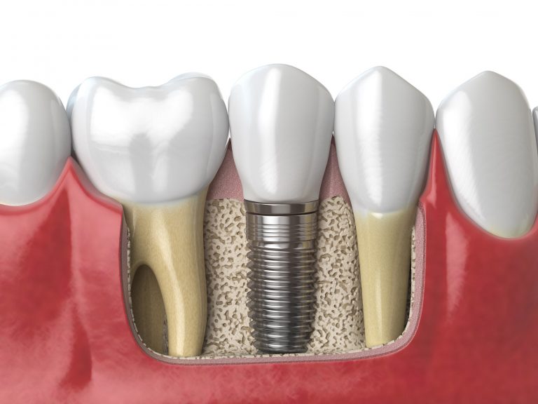 Dental Implants NYC BIOS