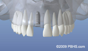 Dental implants dentist NY