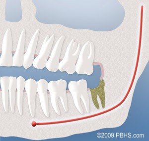 Socket Preservation