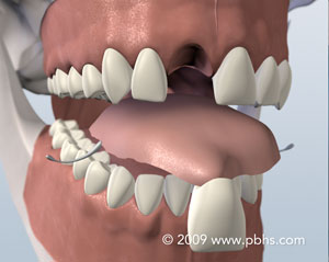 Replacing Missing Teeth