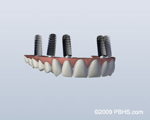 Missingallall implants