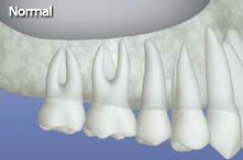 Sinus lift animation