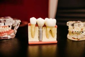 Dental Implants NYC