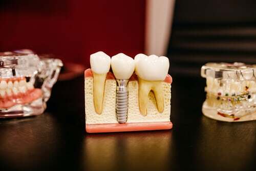 Dental Implants NYC